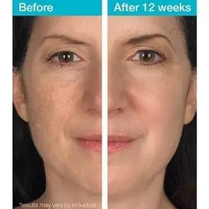 Before and After dark spot correcting