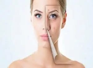 Half viewed face with acne